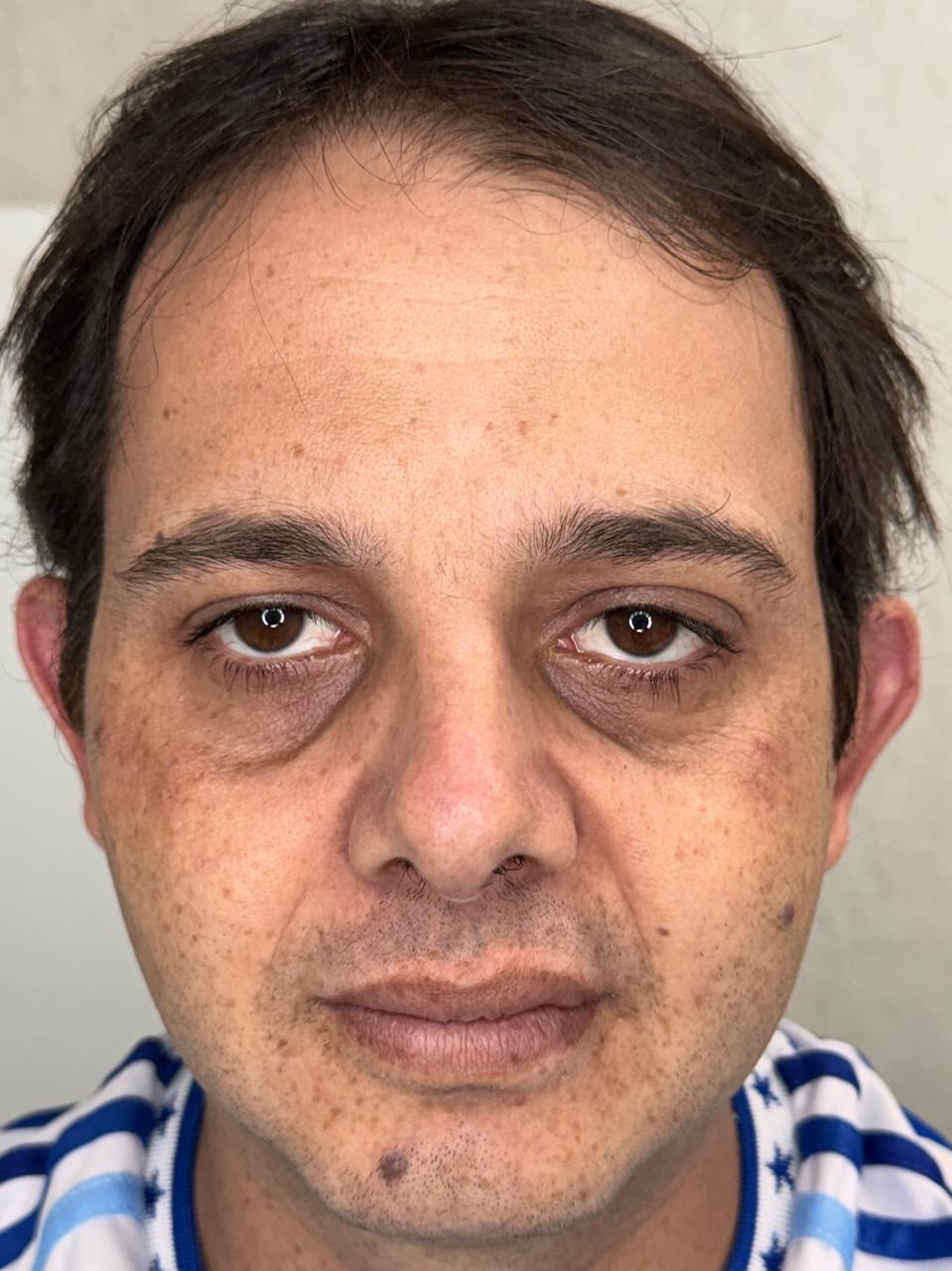 Antes - Skinbooster