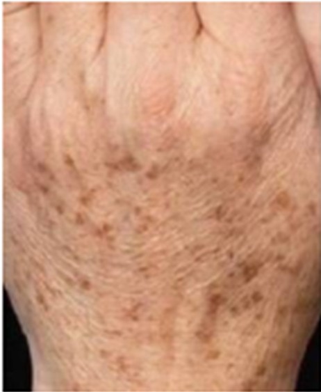 Antes - Jato de Plasma