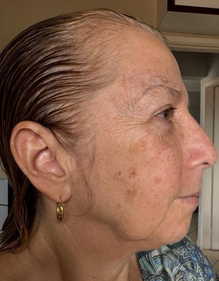 Antes - Peeling sem descamação