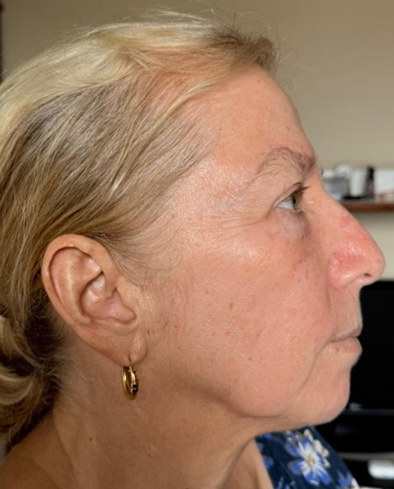 Depois - Peeling sem descamação